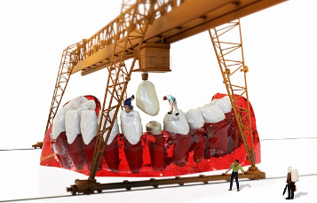 임플란트 시술의 평균 비용