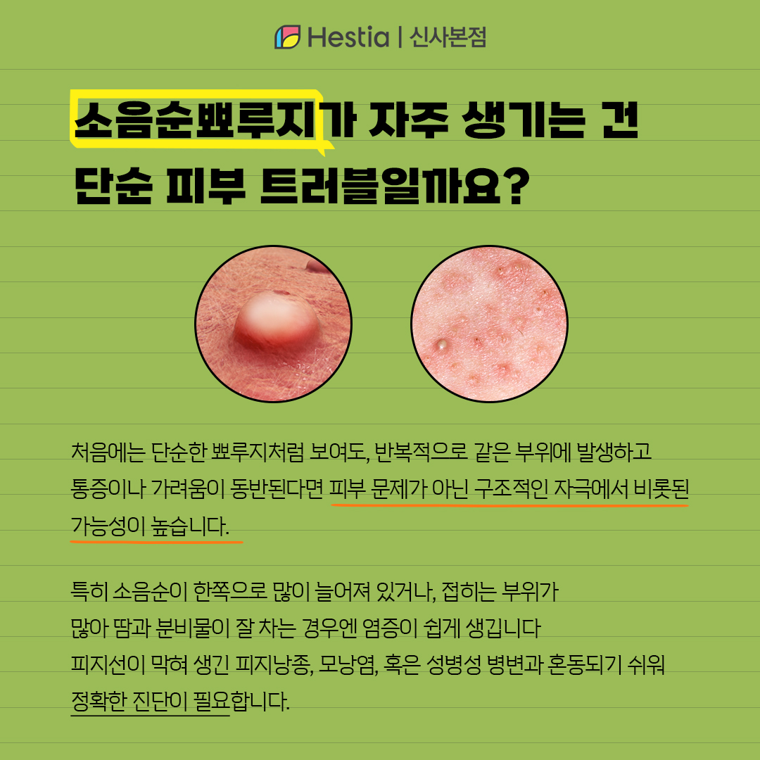 소음순뾰루지 자주 생기는건 단순 피부 트러블인가요?