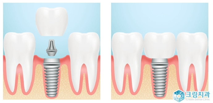 임플란트 보철재 비교 총정리 (Gold PFM Zirconia )