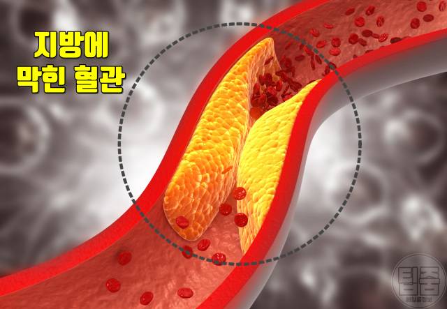 밥 빨리 먹으면 동맥경화 증상 원인