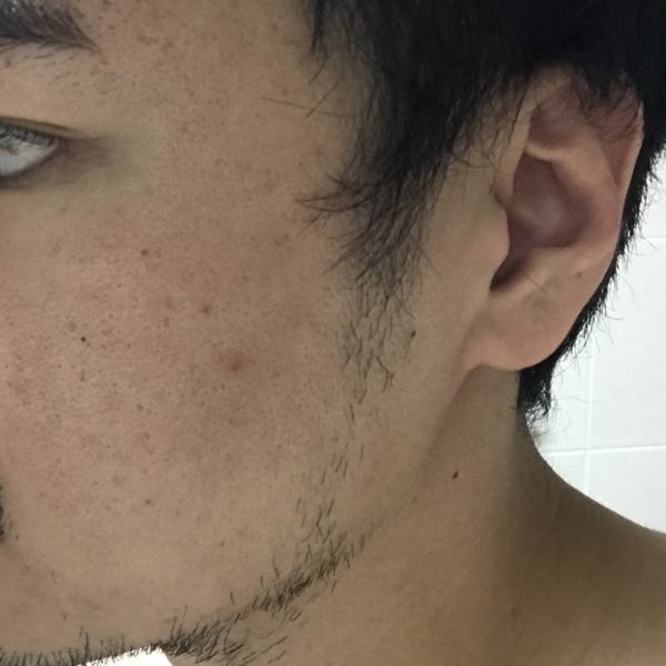 미녹시딜 수염 발모 2개월 차, 솜털 사이사이로 굵은 수염이 올라오는 모습