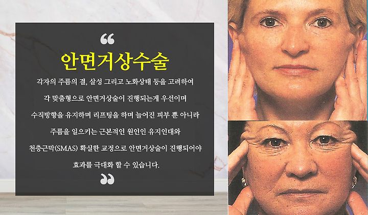 안면거상리프팅