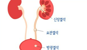 쏘팔메토의 효능 