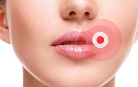 헤르페스 1형 치료 약 연고 