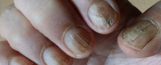 손톱 갈라짐3