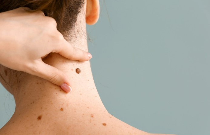 검버섯 없애는 방법