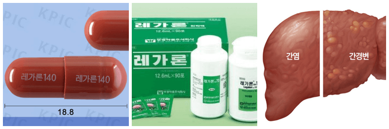 레가론캡슐, 간염, 간경변 사진