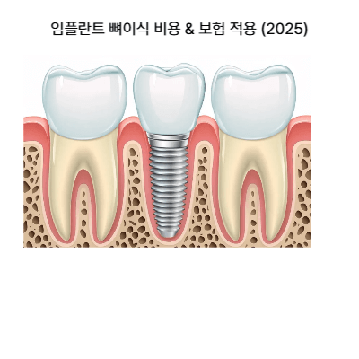 임플란트 뼈이식 비용 &amp; 보험 적용 (2025)