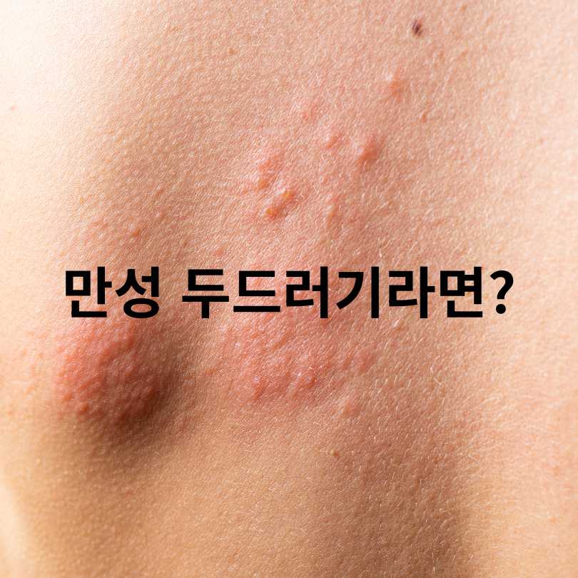 두드러기 간지러움 심할 때 해결방법과 원인