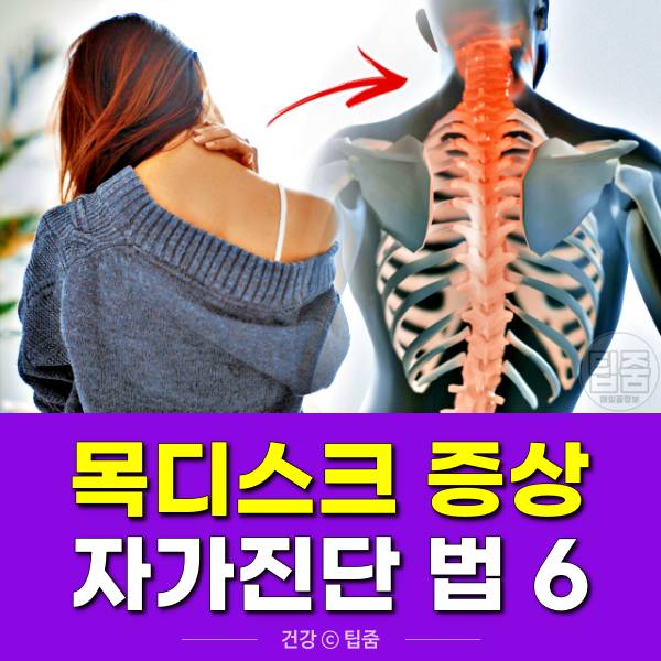 목디스크 증상 자가진단,팁줌