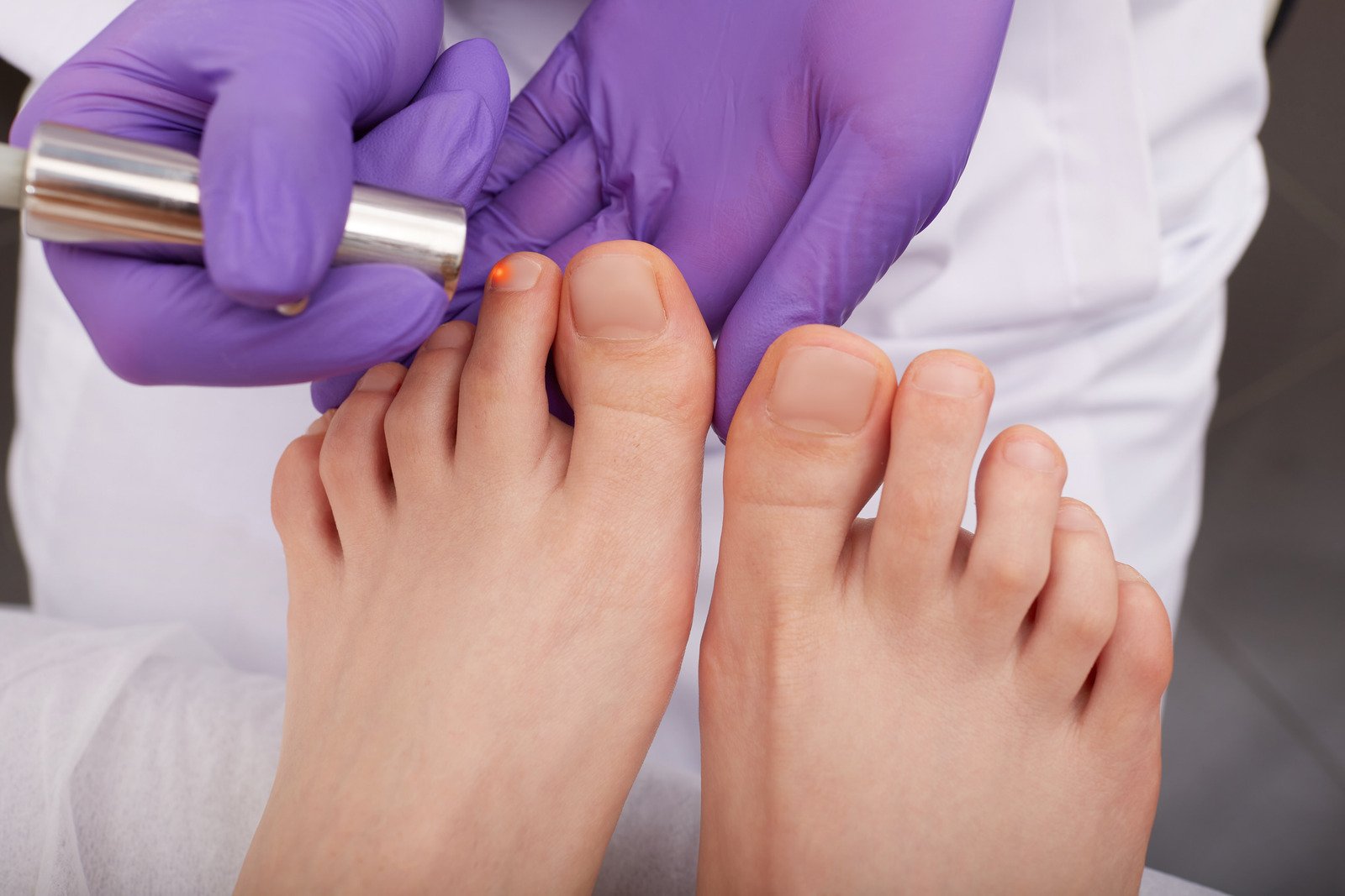 사이클로피록스 네일라카 사용법 – 발톱 무좀 치료를 위한 정확한 방법