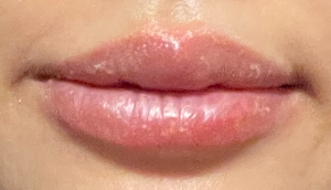 박탈성구순염-중기-입술붓고-열감