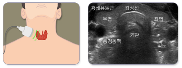 갑상선 초음파 검사