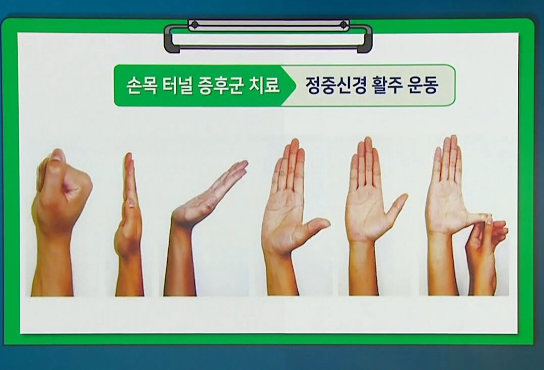 손목터널증후군-치료