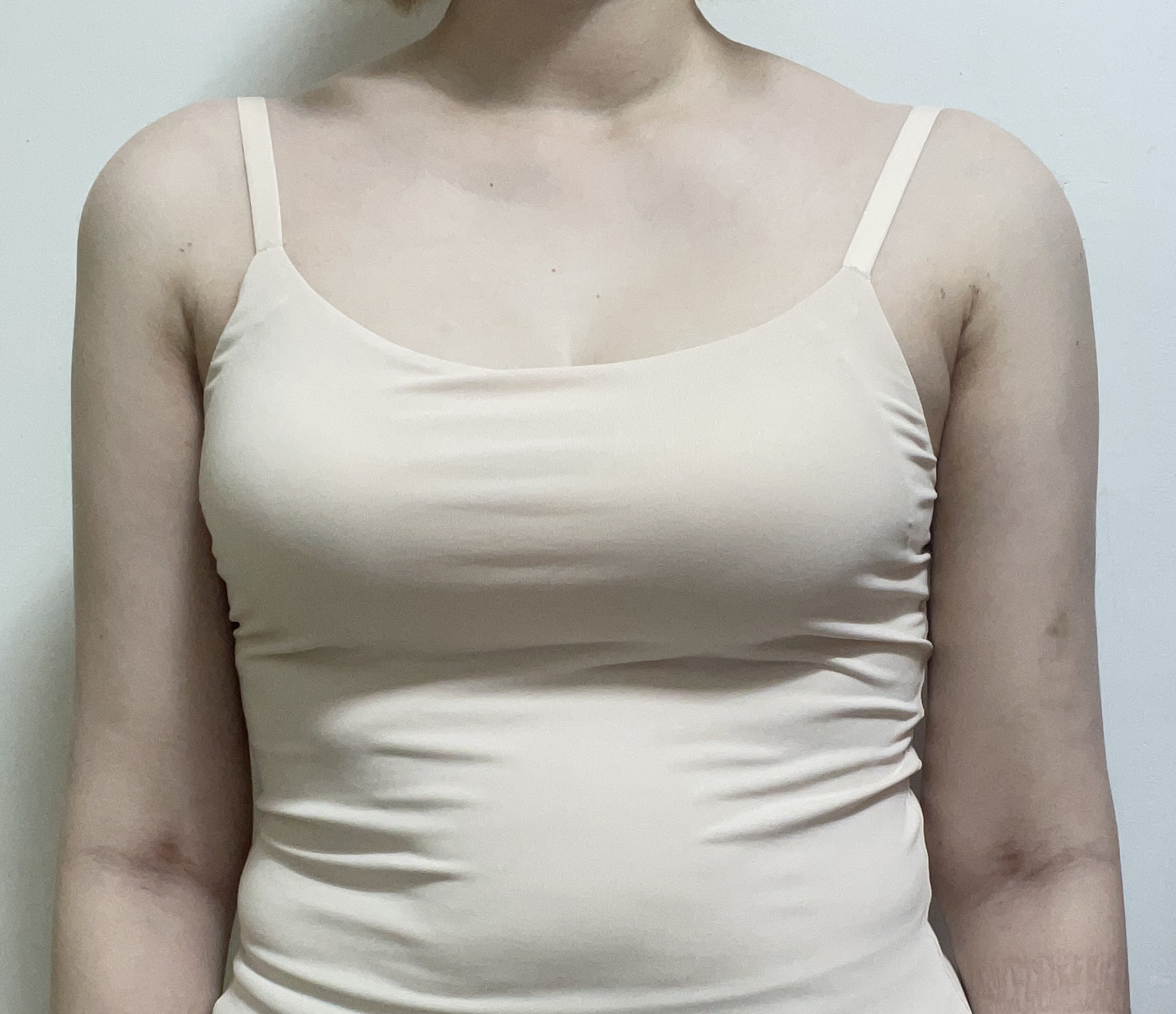 3주 경과한 정면 모습.