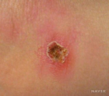 쯔쯔가무시 예방법