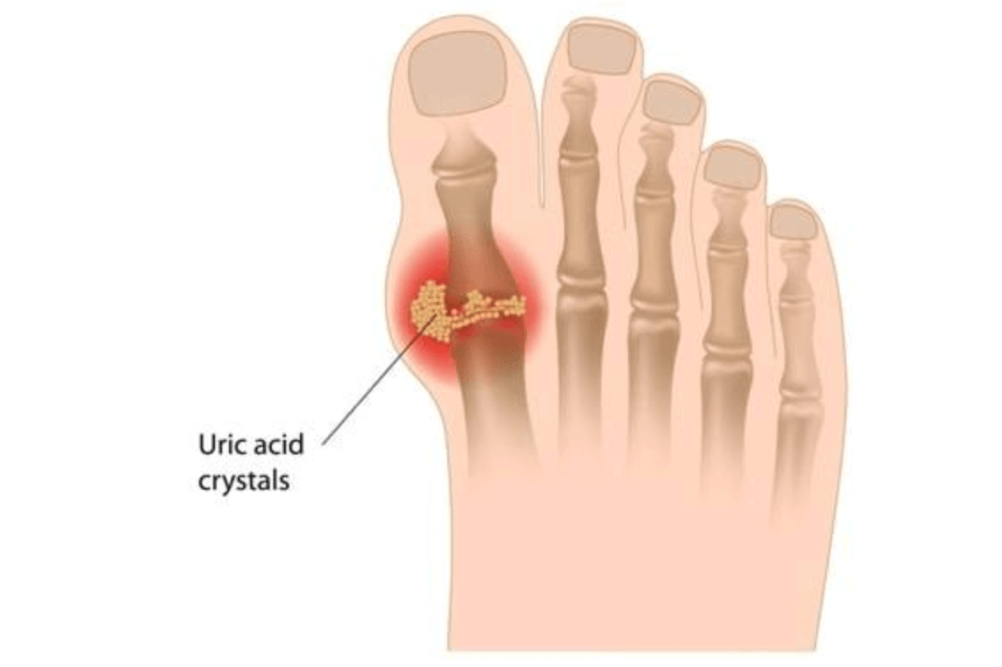 엄지발가락 통증 원인