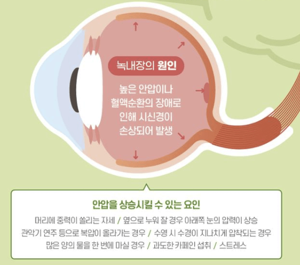 녹내장 요인