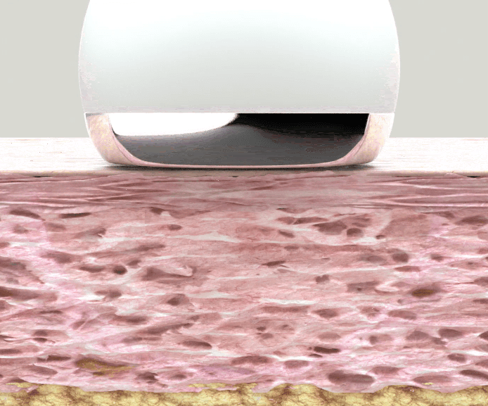 고주파 마시지 원리