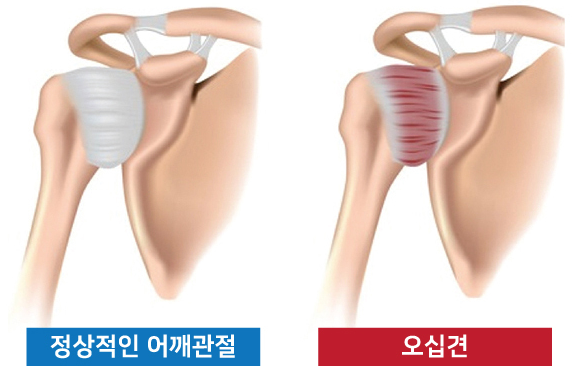 오십견 증상