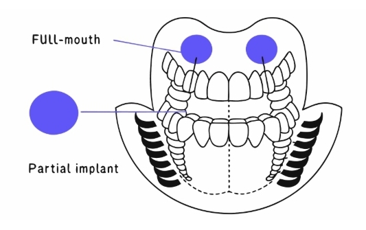 임플란트 수술과정
