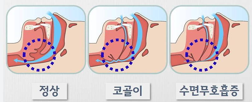 코골이 줄이는 방법