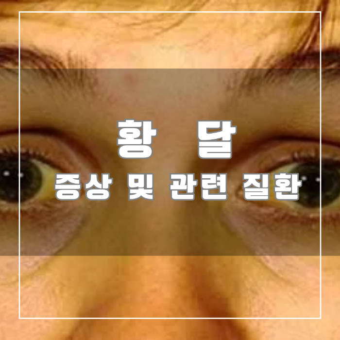 황달의 증상 및 관련 질환