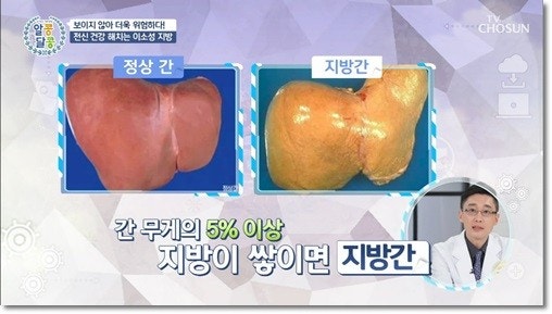 지방간이 생기는 진짜 원인