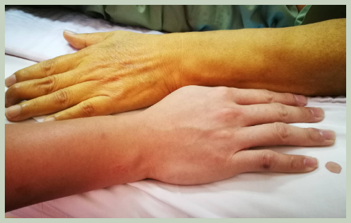 손바닥이 노란이유