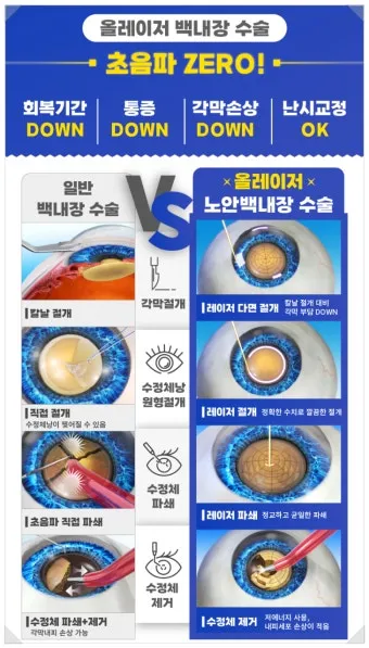 백내장 수술 비용 실비 보험 청구 회복기간_3