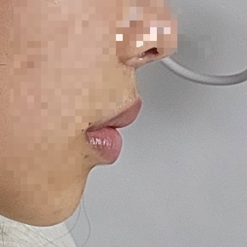 인중 축소 수술 후기