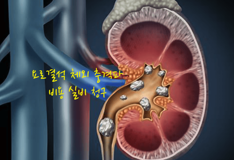 요로결석