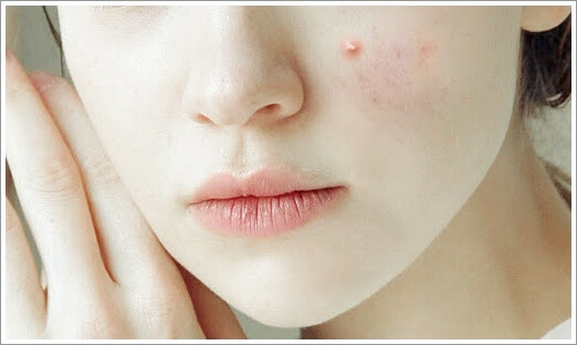 여드름 생기는 이유-화장품