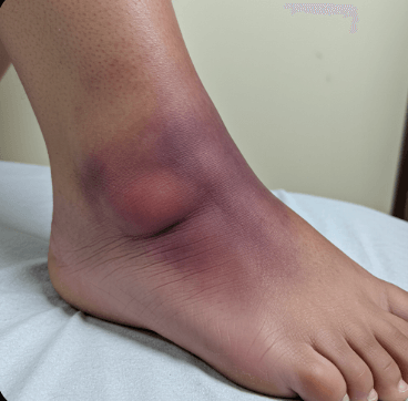 발목 안쪽 통증, 병원 7