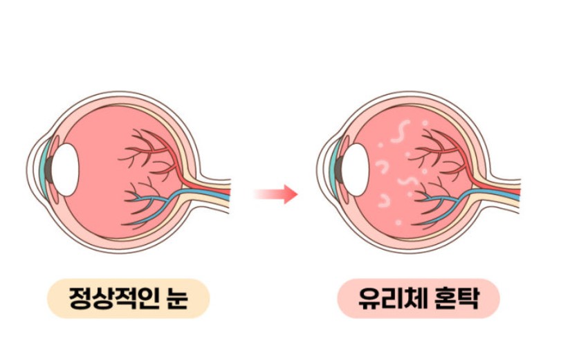 정상적인 눈과 유리체가 혼탁해진 비문증 눈