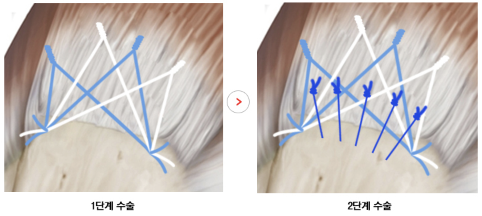 골관통형 회전근개 봉합술