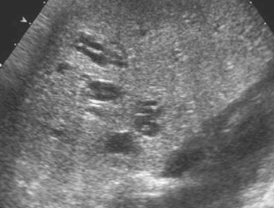 선청성 담관확장증 (Caroli&amp;#39;s disease)