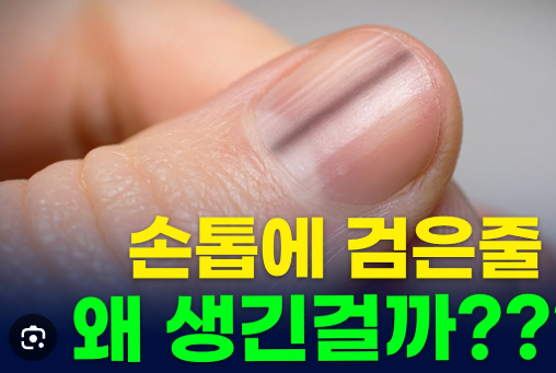 손톱 세로줄, 갈라짐 건강 이상 신호와 해결책