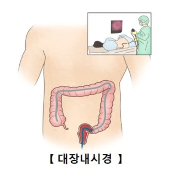 대장내시경 검사 부위