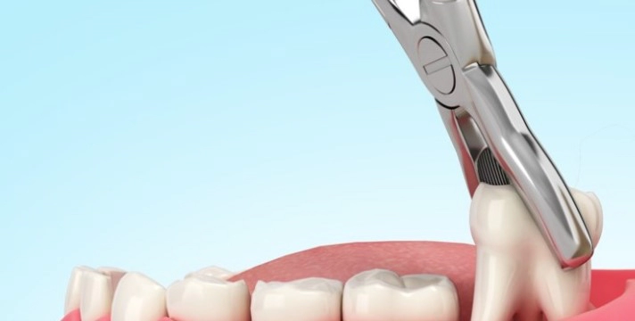 임플란트 시술과정 