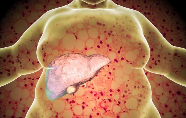 지방간 없애는 방법 — 지방간에 좋은음식 10가지, 원인, 증상, 간수치, 운동 완전정리