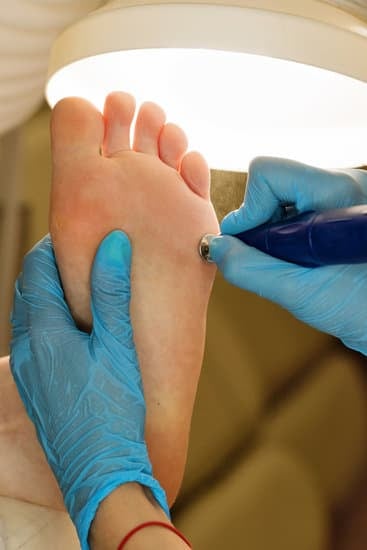 티눈(Corn): 원인, 증상, 치료 및 예방