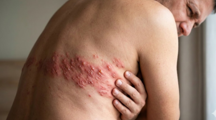 대상포진 관련 이미지