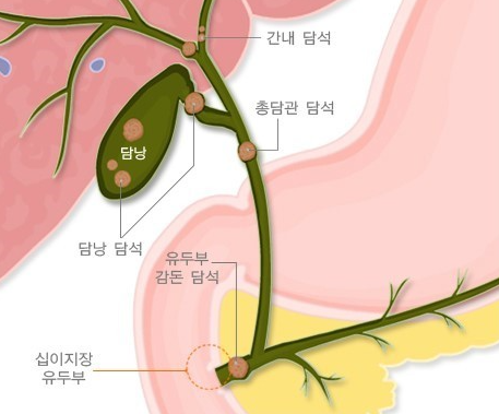담석증 설명 이미지
