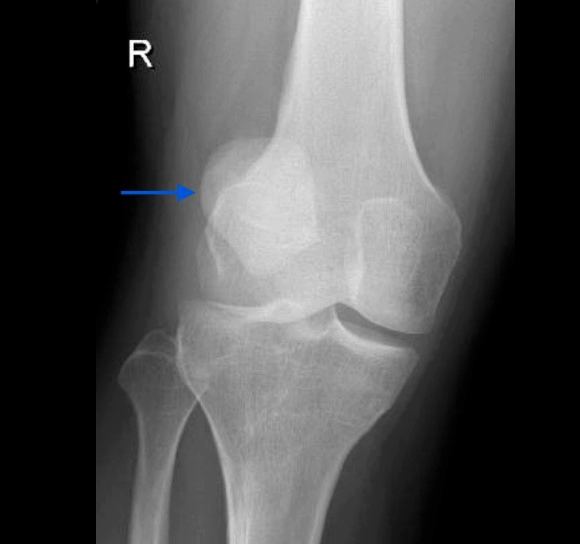 슬개골 탈구 수술