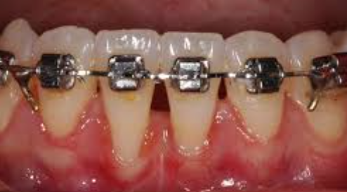 교정 잇몸 퇴축