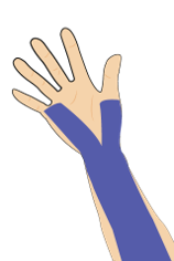 손목 수근관 증후군과 다한증을 동시에 가진 경우