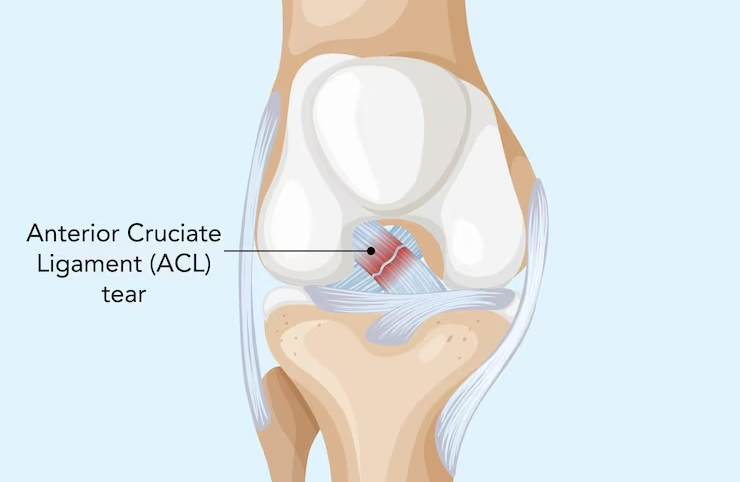 고관절 통증 증상