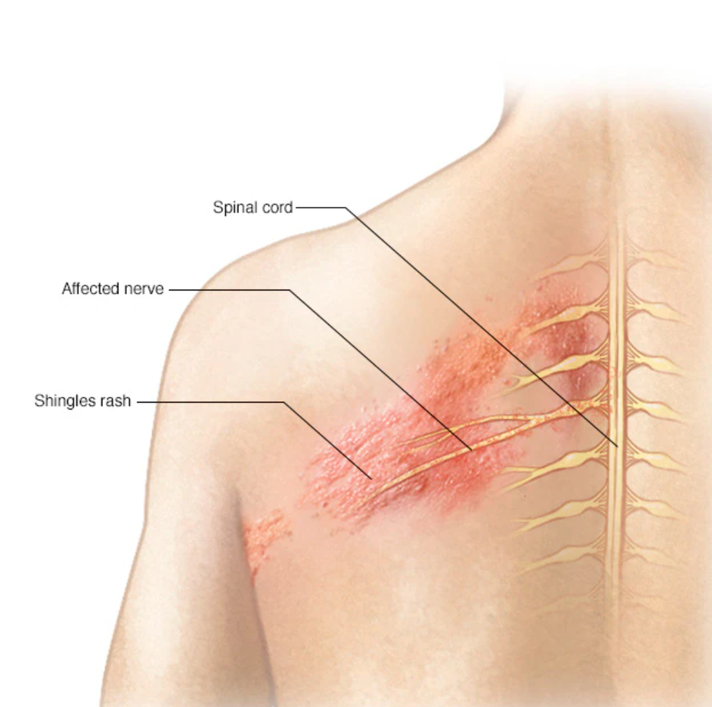 대상포진 급증과 고령층 건강 문제 관련 이미지