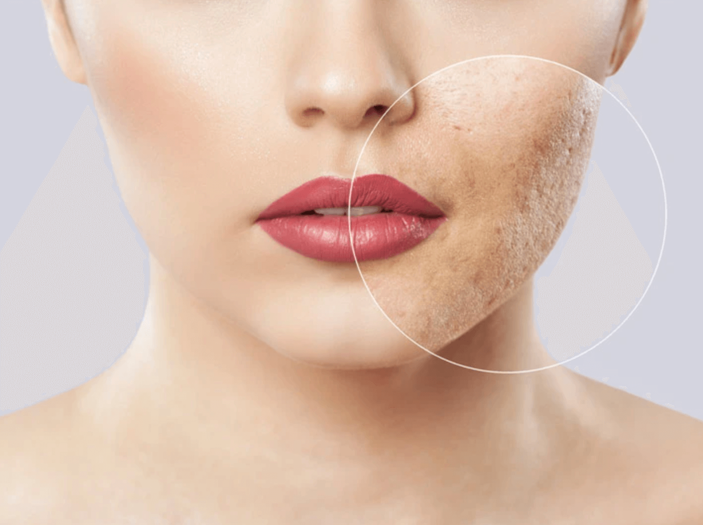 기미-잡티-제거